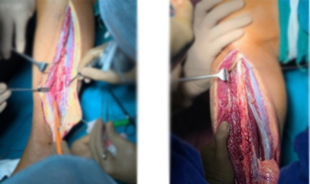 Jaw Bone Cancer Treatment in Hyderabad